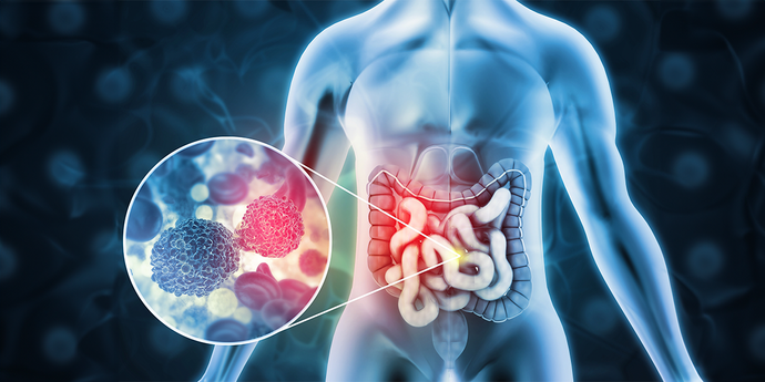 Unique Pathogenic Bacteria Identified as Driver of Colon Cancer:  Raises Possibility of Novel Diagnostic and Therapeutic Targets